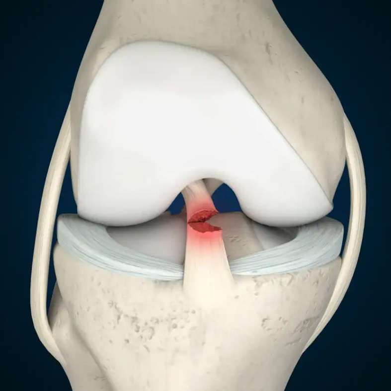 At OrthoPlus Bone and Joint Center, we provide specialized care for ACL tears, offering expert diagnosis and advanced treatment options to support optimal recovery and return to activity.