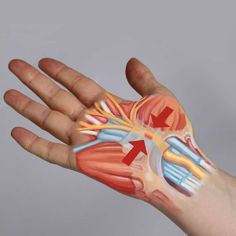 At OrthoPlus Bone and Joint Center, get expert diagnosis and treatment for Carpal Tunnel Syndrome, focusing on relieving symptoms and restoring hand function through personalized care.