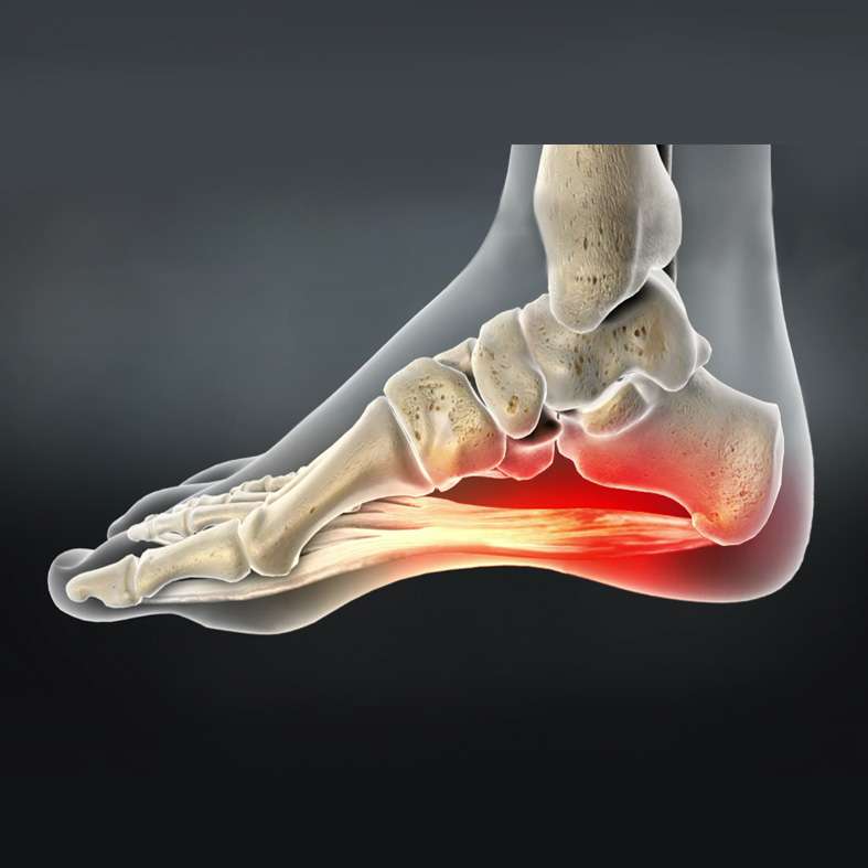 At OrthoPlus Bone and Joint Center, we specialize in diagnosing and treating heel pain and plantar fasciitis, offering targeted treatments to relieve discomfort and restore mobility