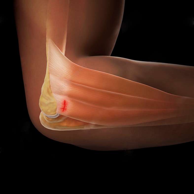 At OrthoPlus Bone and Joint Center, we offer expert diagnosis and treatment for lateral epicondylitis (tennis elbow), focusing on personalized care to relieve pain and restore elbow function.