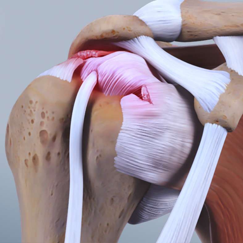 At OrthoPlus Bone and Joint Center, we offer advanced shoulder arthroscopy procedures for precise diagnosis and effective treatment of shoulder injuries, enhancing recovery and function.