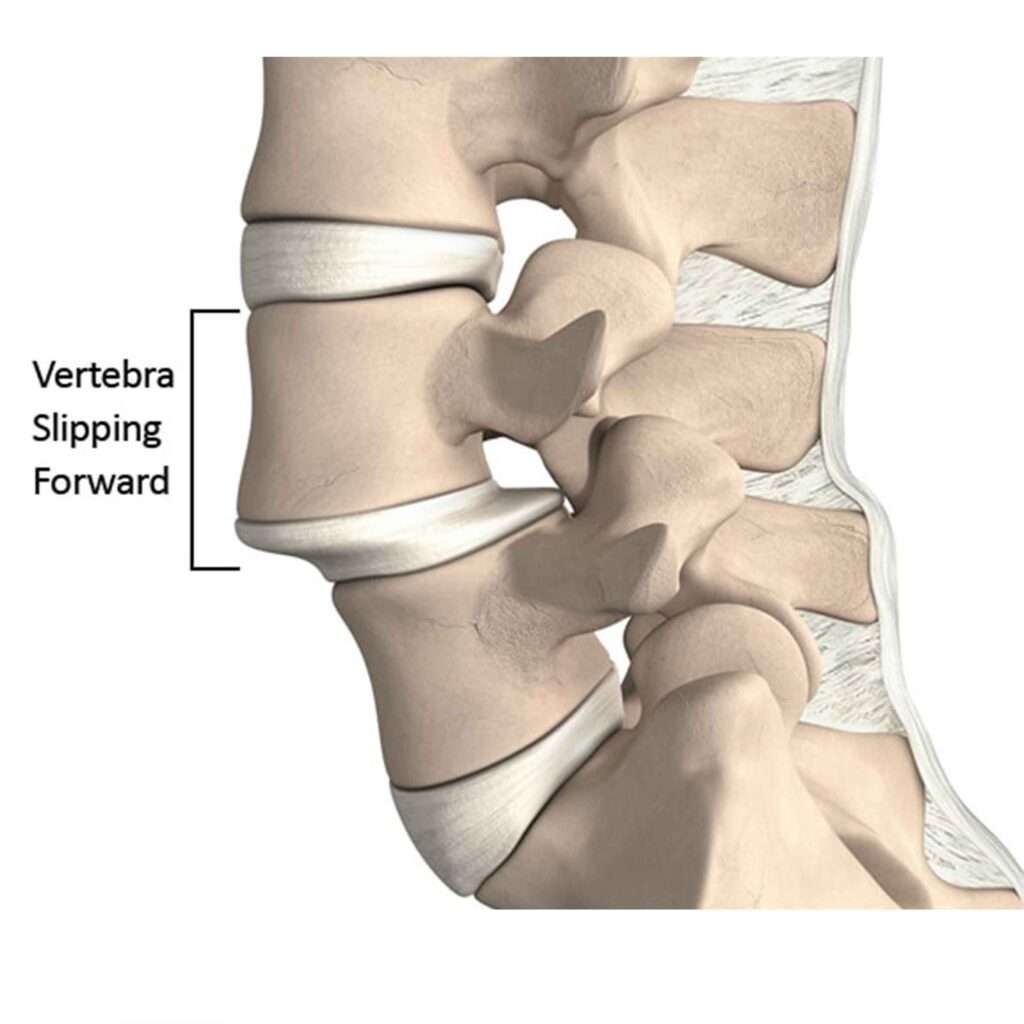 At Orthoplus Bone and Joint Center, we provide expert care for spondylolisthesis, offering advanced diagnosis and effective treatment to restore spinal health and alleviate discomfort.