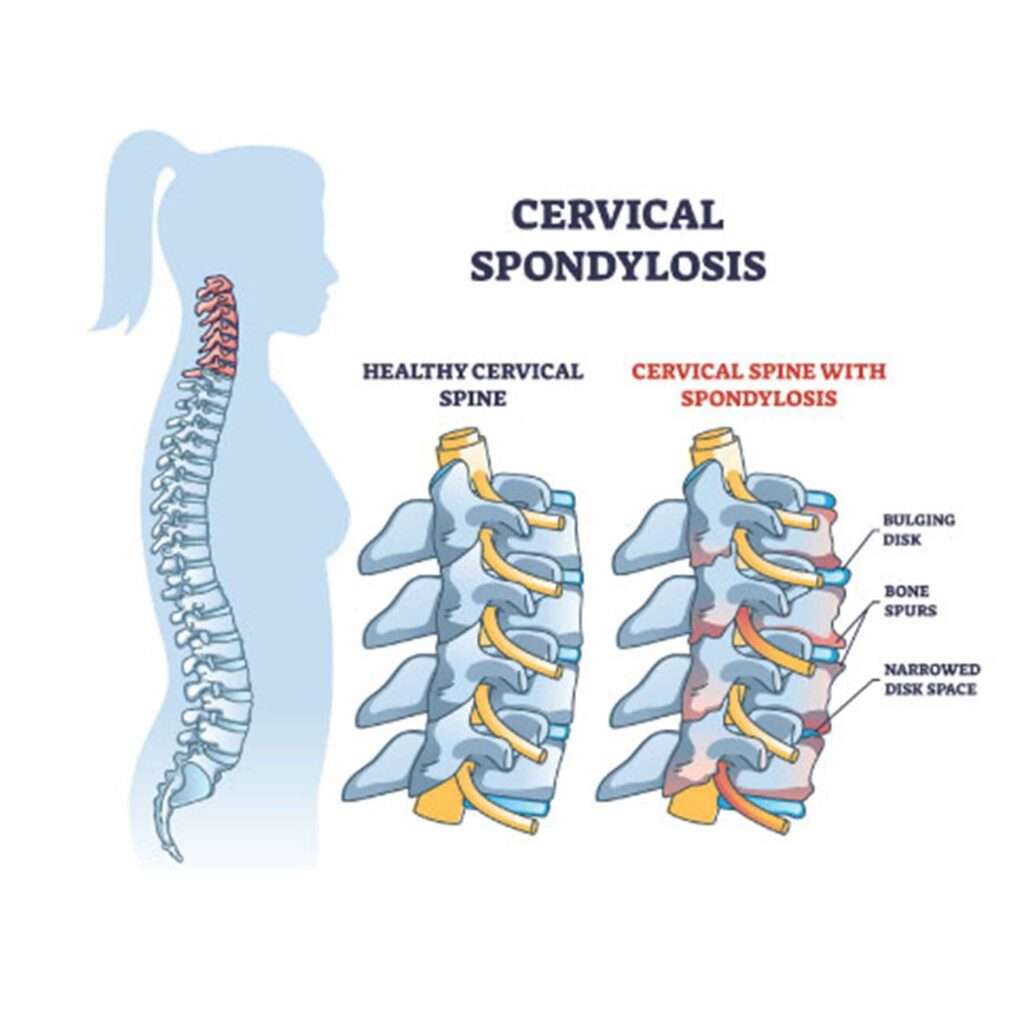 At Orthoplus Bone and Joint Center, we provide comprehensive diagnosis and treatment for cervical spondylosis, offering personalized care to relieve symptoms and improve neck function.