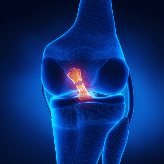 Uncover key information about Anterior Cruciate Ligament (ACL) tears, including how to diagnose, treat, and recover from this injury for a successful return to full activity.