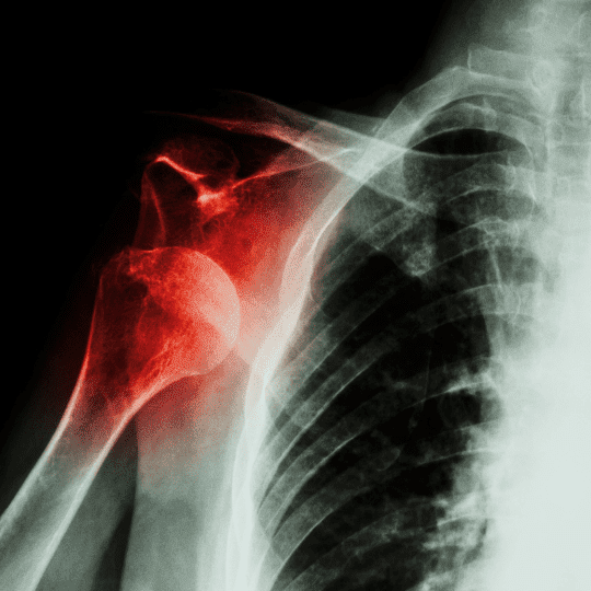 Explore acute anterior shoulder dislocation with insights into its causes, symptoms, and treatment options, to better understand and manage this common injury.